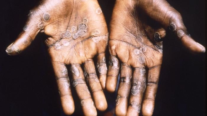 Scale up Mpox response, health groups urge