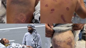 Bruises on the backs and limbs of Global Sumud Flotilla activists